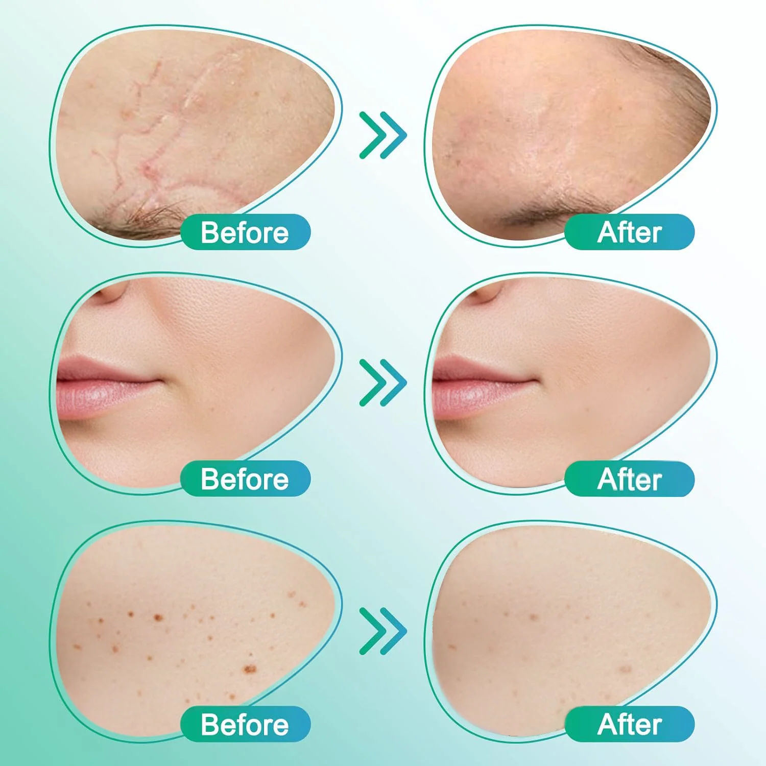 โ
๐๐ฎ๐ฟ๐ฒ๐๐ฟ๐ฒ๐ฒ๐๐ฒยฎ 3-in-1 Microneedle Care Patch - Image 3